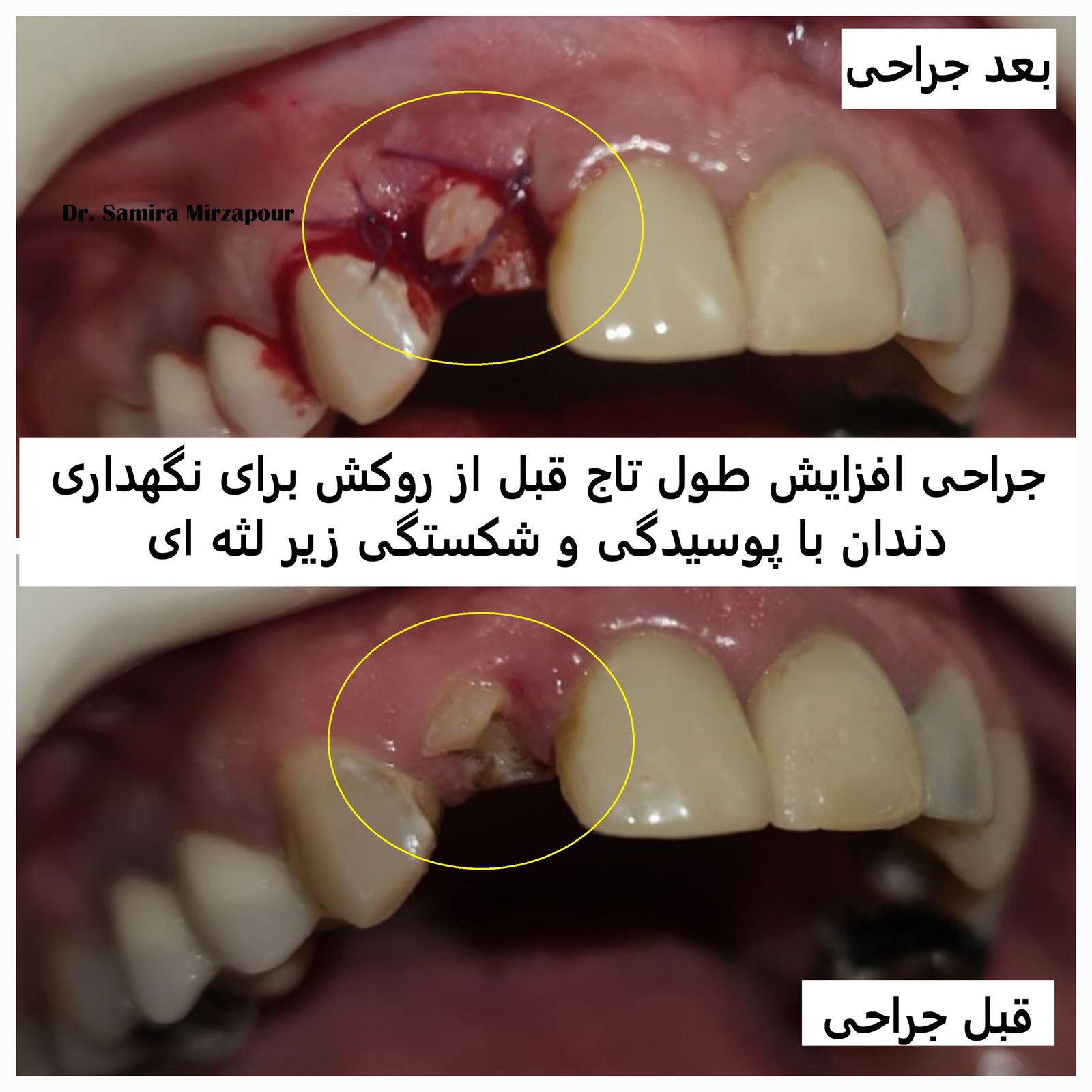 افزایش طول تاج بالینی — تصویر بالینی
