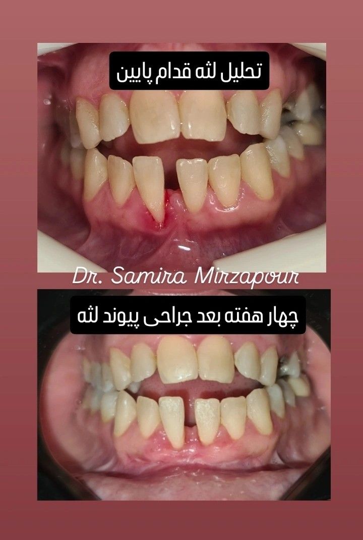 پیوند لثه — تصویر بالینی