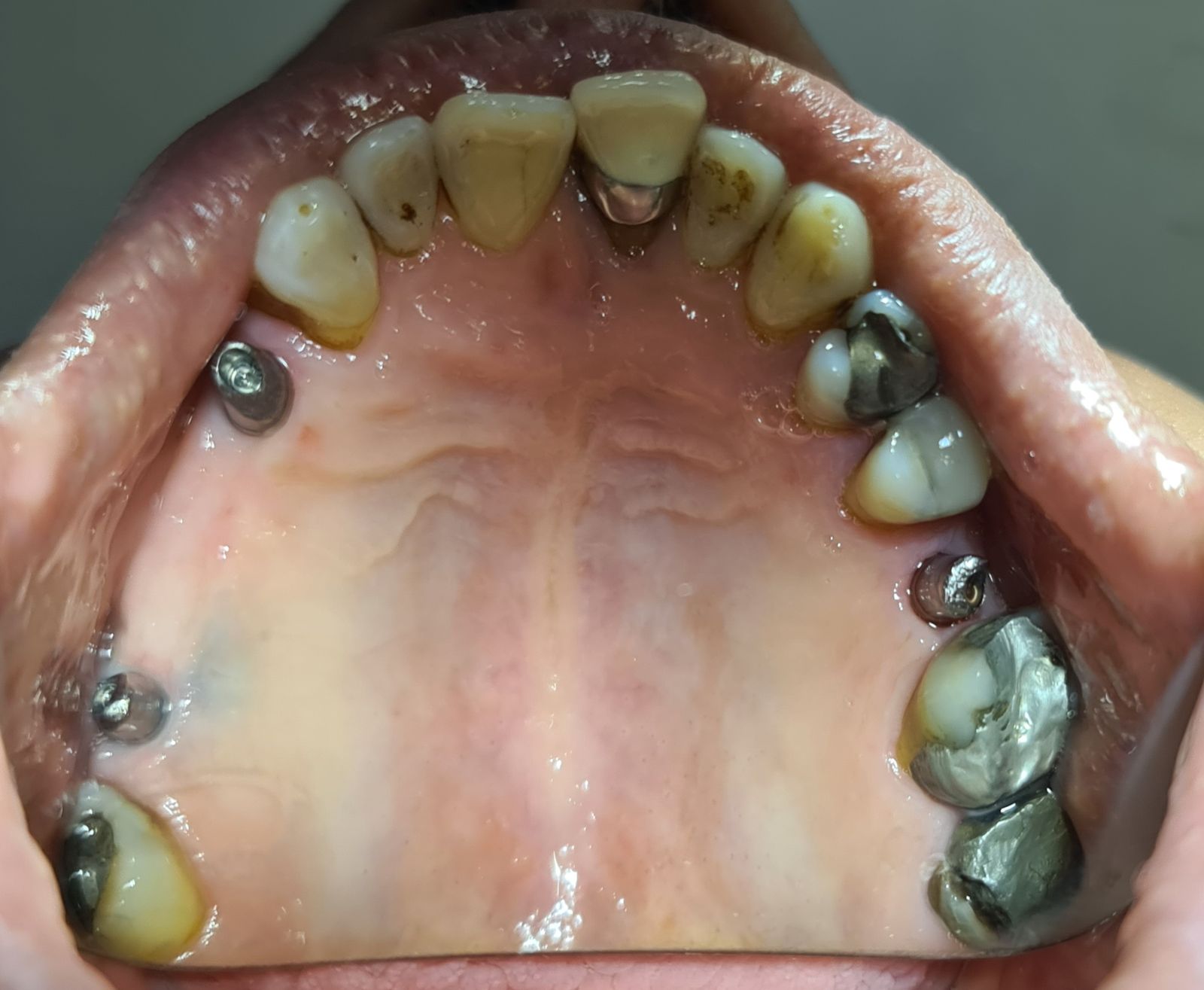 جراحی و جایگذاری ایمپلنت — تصویر بالینی