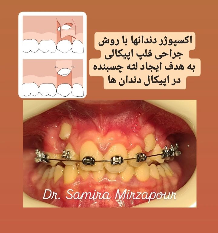 اکسپوژر جراحی دندان برای ارتودنسی — تصویر بالینی