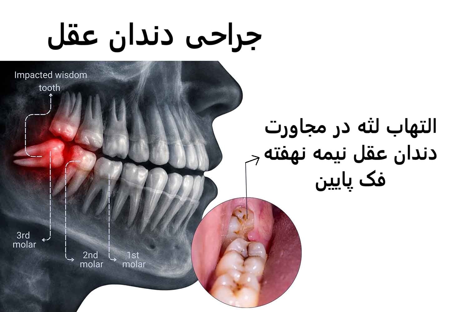 جراحی دندان عقل